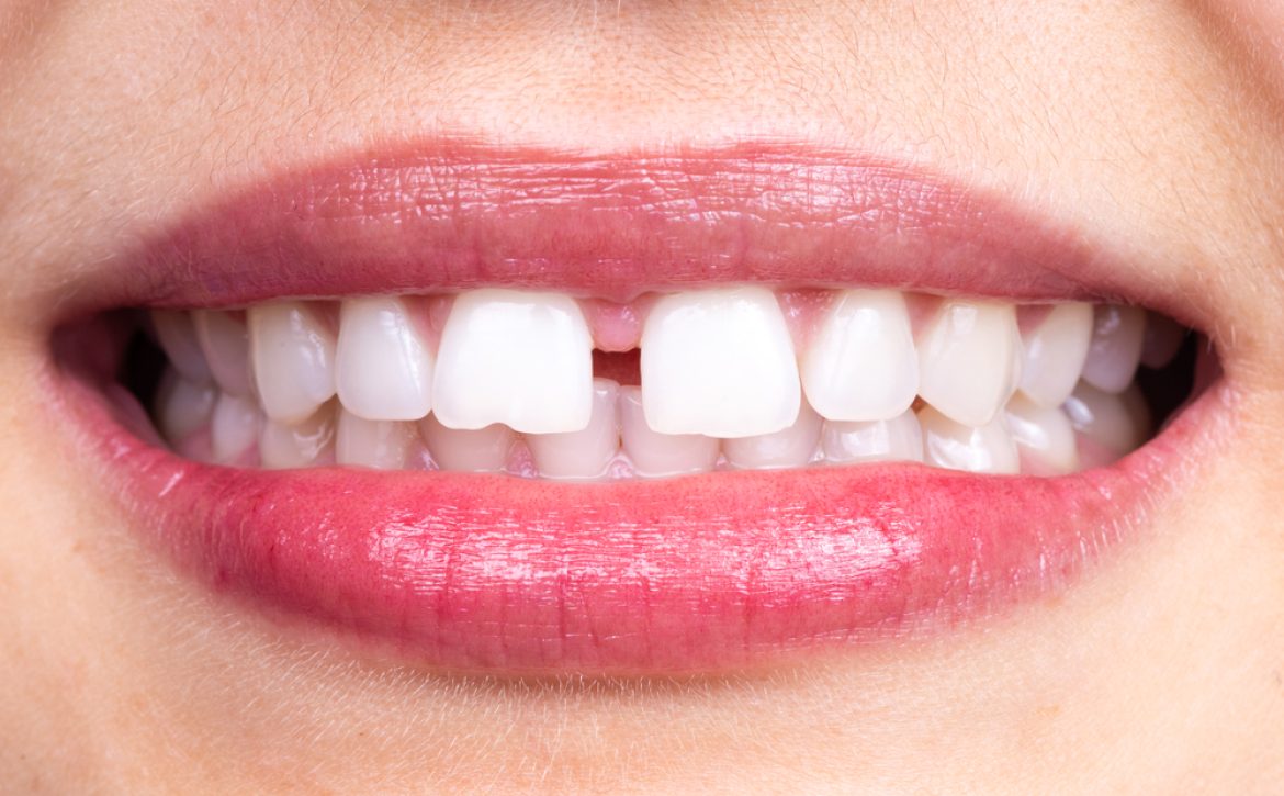 Diastema,Between,Tooth.,Spacing,Between,Front,Teeth