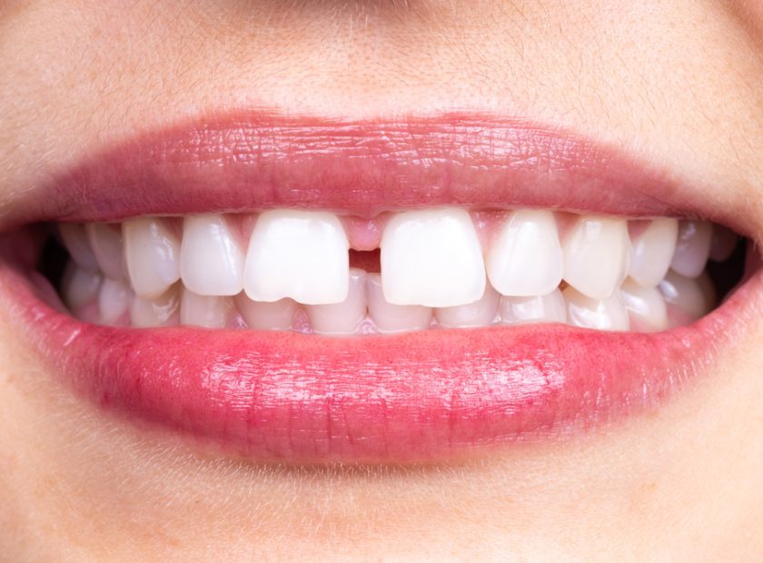 Diastema,Between,Tooth.,Spacing,Between,Front,Teeth
