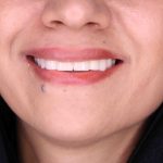  انواع روکش های دندانی کدامند