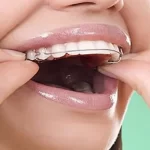 بعد از درمان ارتودنسی